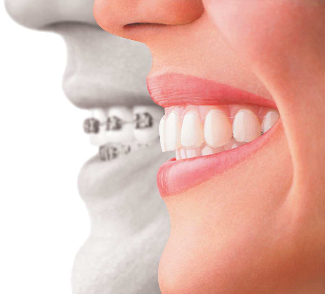Adult_aligner006